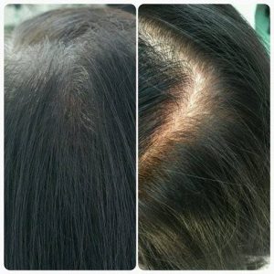 Scalp Micropigmentation for Women Example of how scalp micropigmentation can be used to help women by Better Hair Transplant Clinics