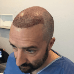 A Better Hair Transplant Clinics patient immediately following a hair transplant surgery procedure