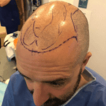 A Better Hair Transplant Clinics patient undergoing final preparation before their hair transplant surgery