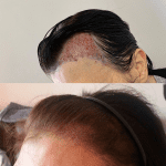 A transgender patient following on from having hair transplant surgery performed to create a more natural hairline