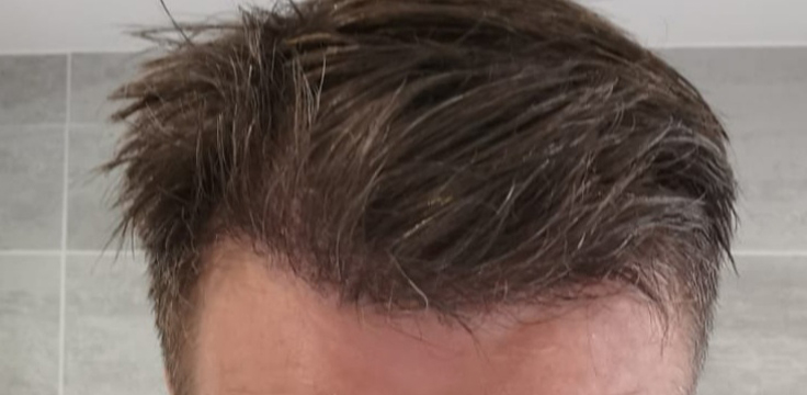 hairline-6m-1