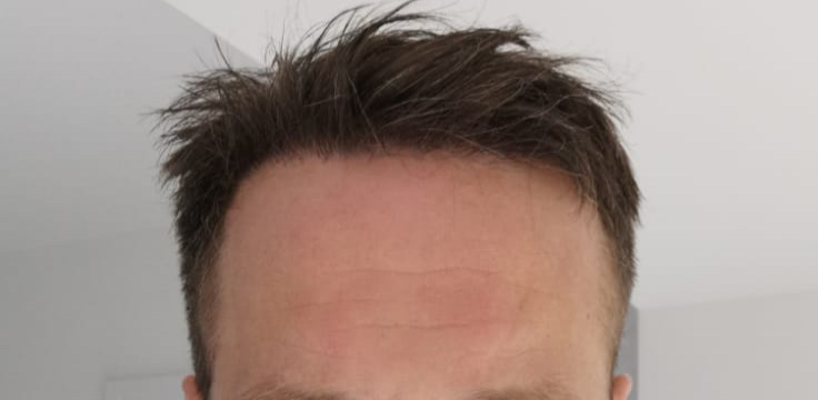 hairline-6m-2