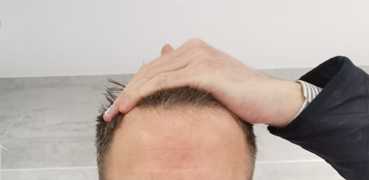 hairline-after