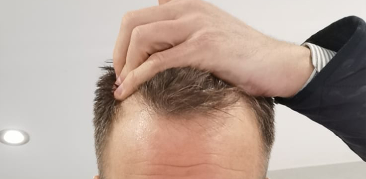 hairline-before