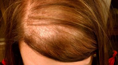 Better Hair Transplant Clinics provide Female Hair Loss Treatments