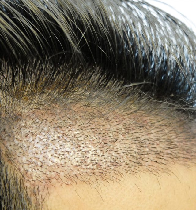 Better Hair Transplant Clinics provide FUE Hair Transplant Procedures