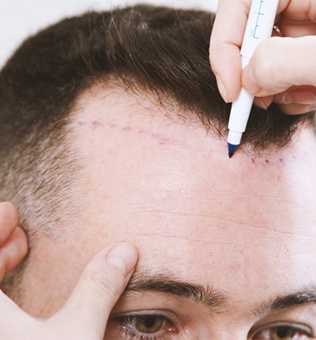 Better Hair Transplant Clinics provide FUT Hair Transplant Procedures