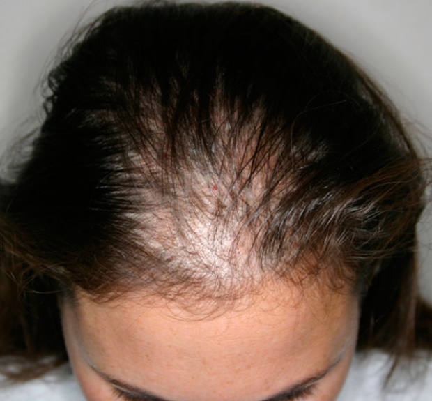 Female hair loss solutions and advice at Better Hair Transplant Clinic Female hair loss solutions and advice at Better Hair Transplant Clinic
