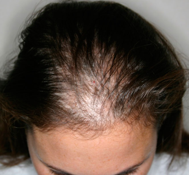 Hair loss within women is a lot more common than most people think and can cause serious issues with mental health