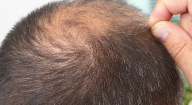 Better Hair Transplant Clinics provide Male Hair Loss Treatments