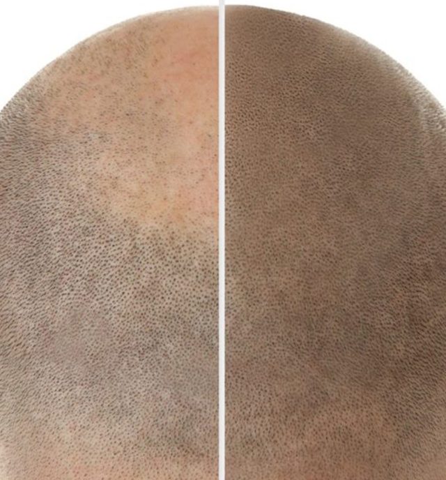 Better Hair Transplant Clinics provide Scalp Micropigmentation Procedures