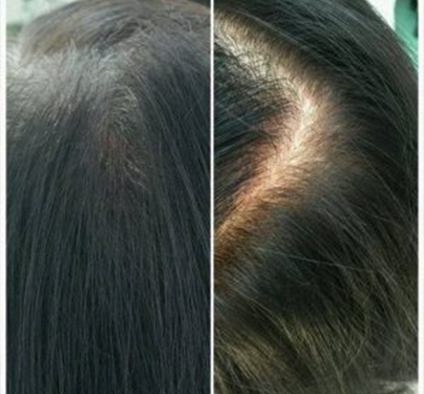 Scalp micropigmentation for women focuses more on creating the illusion of depth and shadow to hide any balding areas